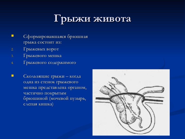 Ущемленная грыжа код по мкб 10