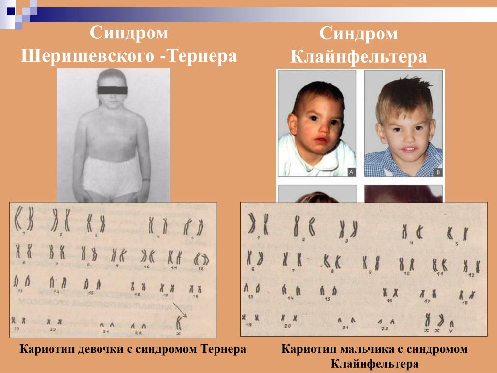 Xxy хромосома. Синдром Клайнфельтера кариотип. Кариотип синдром Клайнфельтера кариотип. Кариотип больного с синдромом Клайнфельтера 47 xxy. Мальчик с синдромом Клайнфельтера кариотип.