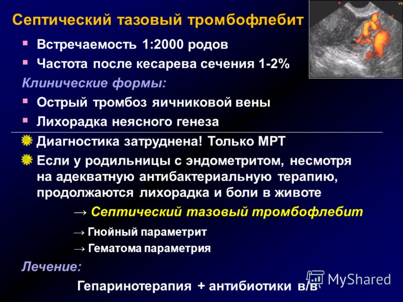 Эндометрит симптомы. Послеродовой тазовый тромбофлебит. Септический тромбофлебит. Септический эндометрит. Гнойно септические заболевания эндометрит.