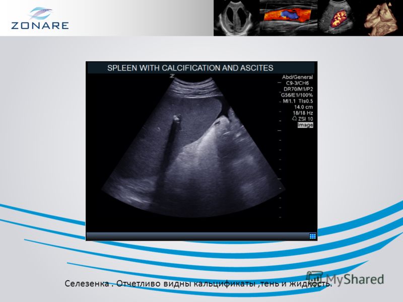 Селезенка армия. Кальцификаты селезенки. Сезенка УЗИ норм.