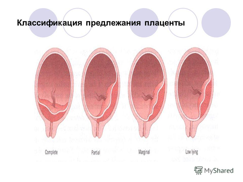 Краевое предлежание плаценты при беременности. Предлежание плаценты классификация. Клиническая классификация предлежания плаценты. Предлнжание плацента классификация. Центральное предлежание плаценты.