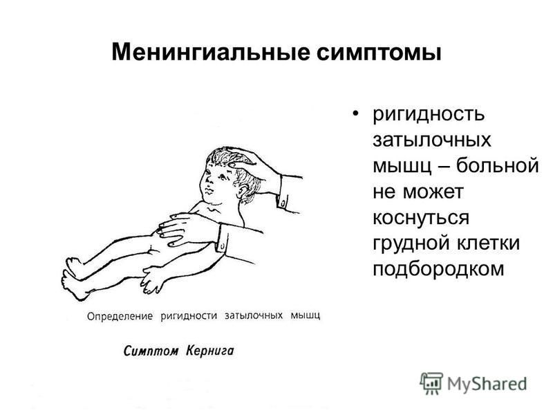 Ригидность мышц затылка симптомы. Менингеальные симптомы ригидность затылочных мышц. Фригидность затылочных мышц. Менингеальные симптомы у детей до года.