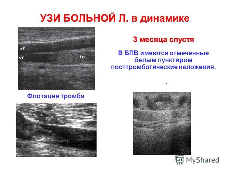 Болит узи. УЗИ В динамике что это такое. Степени флотации тромба по УЗИ. Флотирующий тромб нижней конечности.