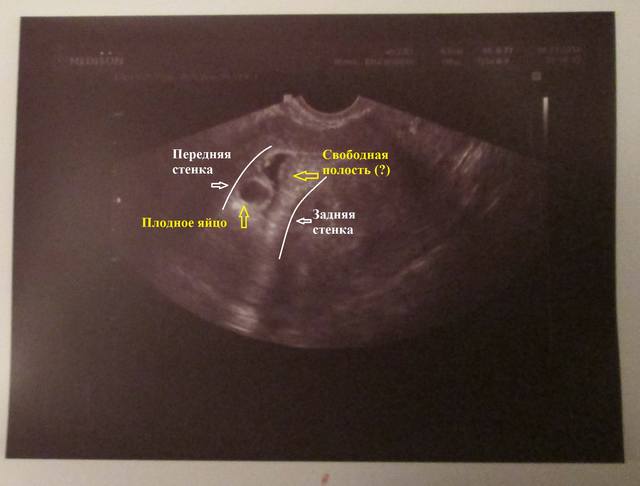 Как опорожняется гематома при беременности фото
