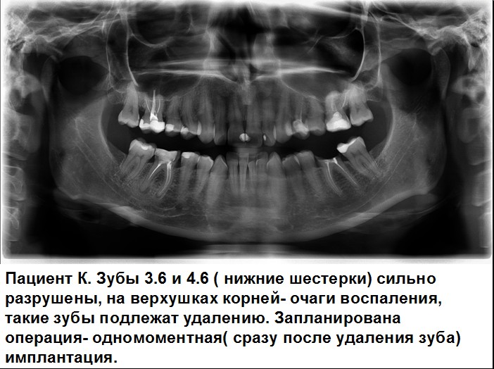 6 зуб снизу. Вырывание шестерки зуб. Зуб шестерка на нижней челюсти.