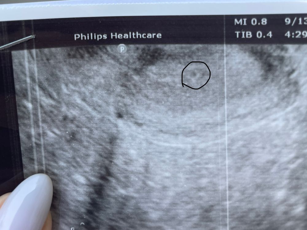 После первого узи. Первое УЗИ. Внематочная беременность 2 недели УЗИ.