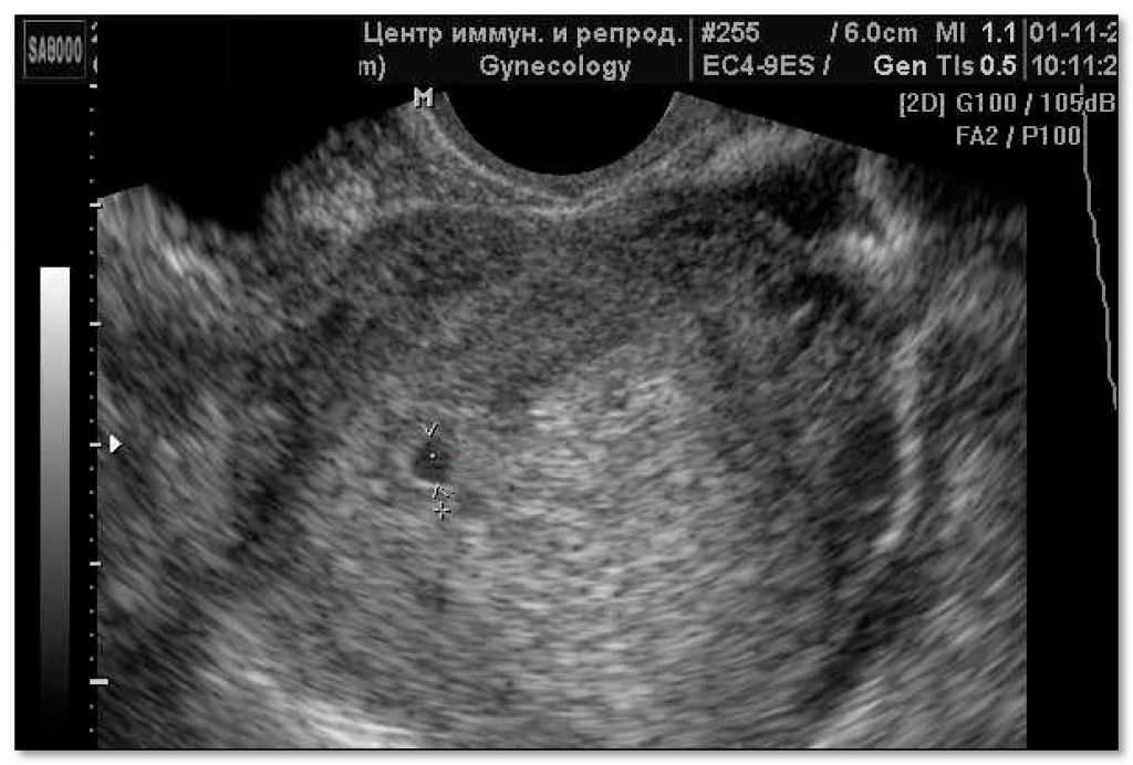 Узи 1 неделя беременности фото