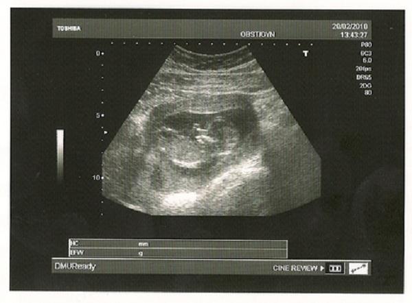 14 недель отзывы. УЗИ 14 недель беременности. УЗИ 13-14 недель беременности. Снимки УЗИ на 14 неделе беременности.