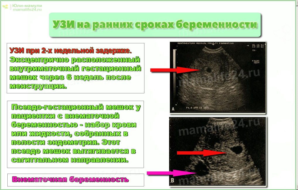 Ли сохранить внематочную беременность. Замершая внематочная беременность на УЗИ. Внематочная беременность по УЗИ. УЗИ беременности на ранних. УЗИ беременности на ранних сроках.