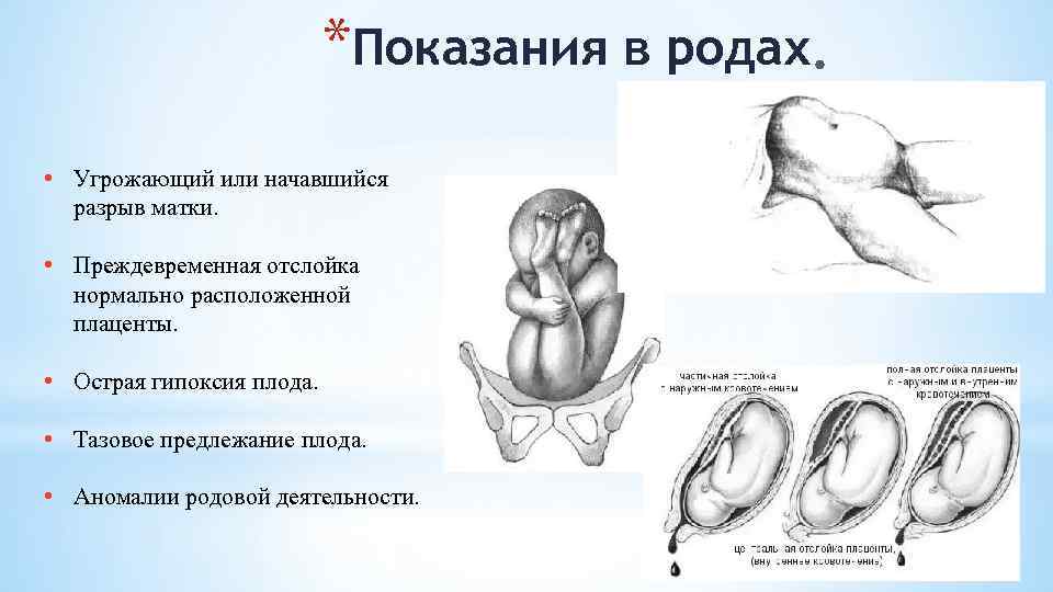 Фото Продольного Предлежания Плода