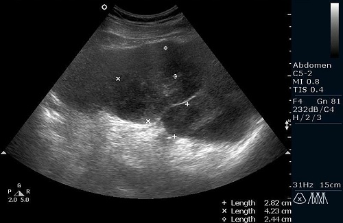 Разрыв селезенки на узи фото
