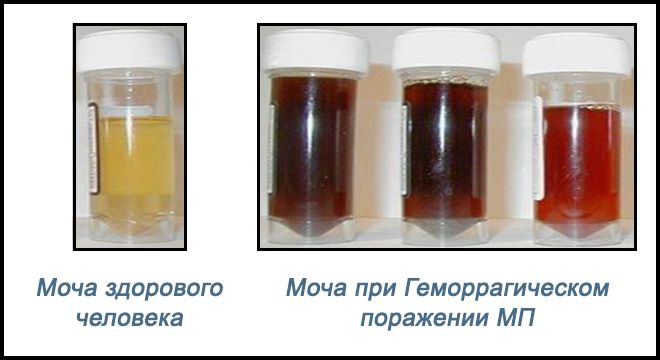 Какого цвета моча при цистите у женщин фото