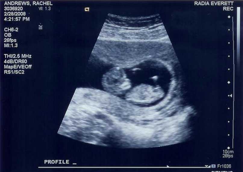 11 неделя признаки. УЗИ 11 недель беременности размер плода. Как выглядит ребенок на УЗИ В 11 недель. УЗИ плода на 11 неделе беременности. УЗИ 10-11 недель беременности фото плода на УЗИ.