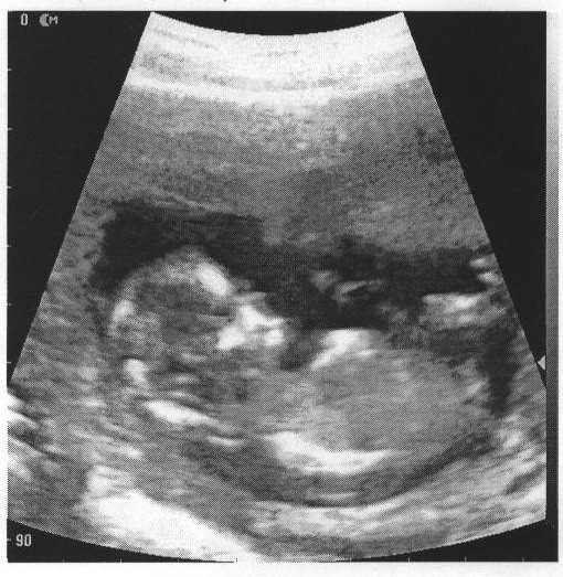 Узи 6 месяцев. Фото УЗИ 5 месяцев беременности девочка. УЗИ ребенка на 4 месяце беременности. УЗИ 3 месяца беременности. УЗИ 3 месяца беременности мальчик.