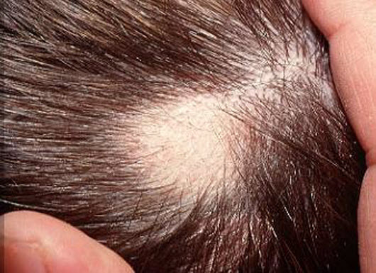 Зуд головы и выпадение волос причины. Очаговая алопеция (alopecia Areata).