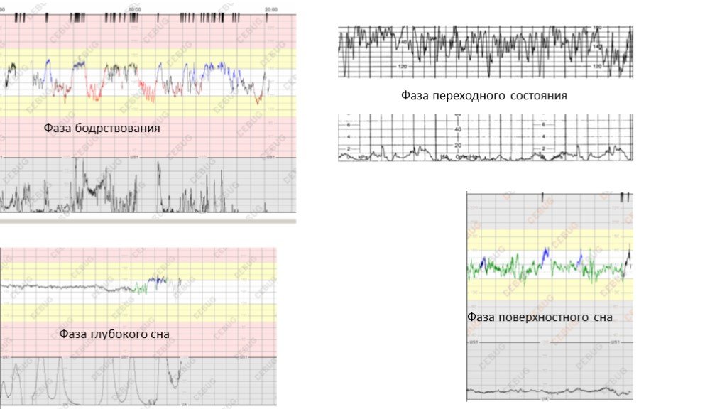 Ктг при схватках фото показатели