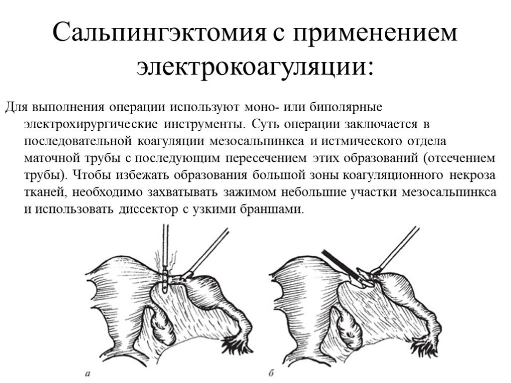 Операция труба. Сальпингэктомия ход операции. Сальпингэктомия протокол операции. Операции при трубной беременности сальпингэктомия. Тубэктомия внематочная беременность.