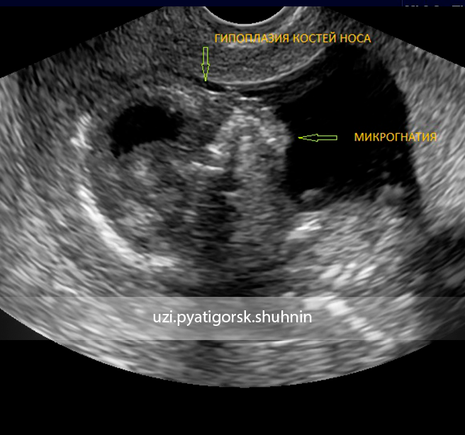 Гипоплазия носовой кости у плода. Гипоплазия костей носа у плода. Гипоплазия носовой кости УЗИ.
