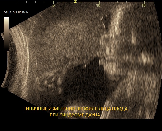 Узи пятигорск отзывы. УЗИ В динамике что это такое. Кальцинаты тела матки на УЗИ что значит. Шухнин УЗИ Пятигорск. Что за цифры говорят на УЗИ.