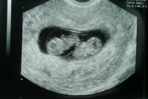 Фото узи 9 недель 4 дня беременности