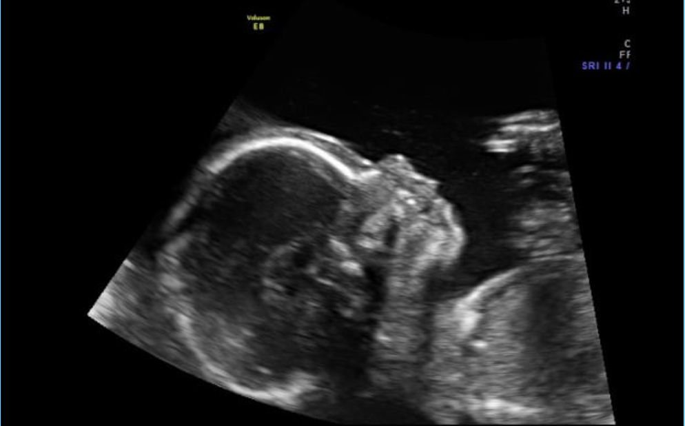 Мальчик 20 недель беременности. Носовая кость УЗИ плода. УЗИ носовой кости плода. УЗИ беременность носовой кости плода. Носовая кость плода в 20 недель на УЗИ.