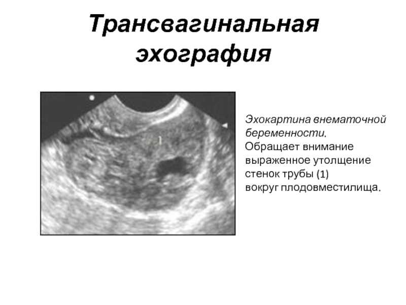 Как отличить внематочную. Трансвагинальная эхография внематочной беременности. Внематочная беременность УЗИ признаки. Внематочная беременность эхография. Внематочная Трубная беременность.