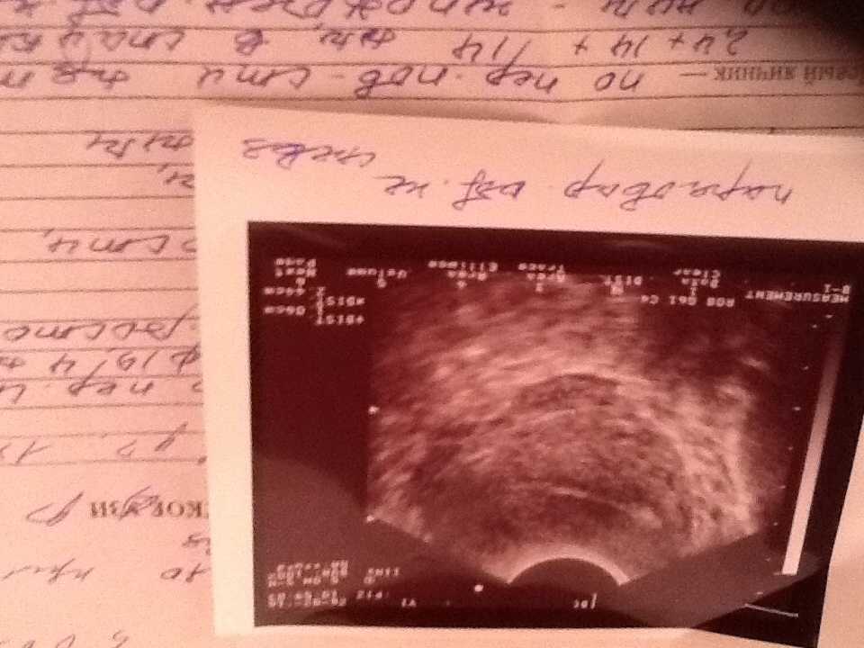 Беременность через месяц после замершей беременности