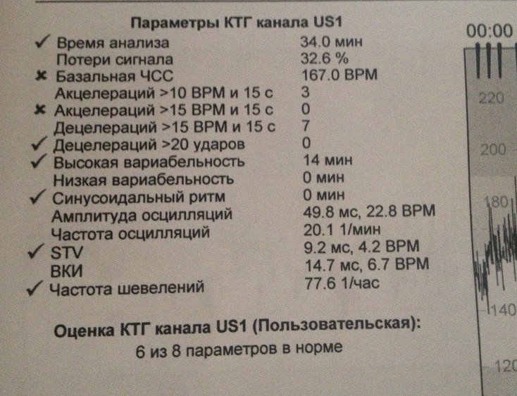 Ктг при беременности баллы. КТГ расшифровка норма. КТГ STV 12,6.