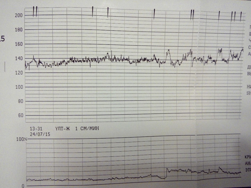 Ктг при беременности что это