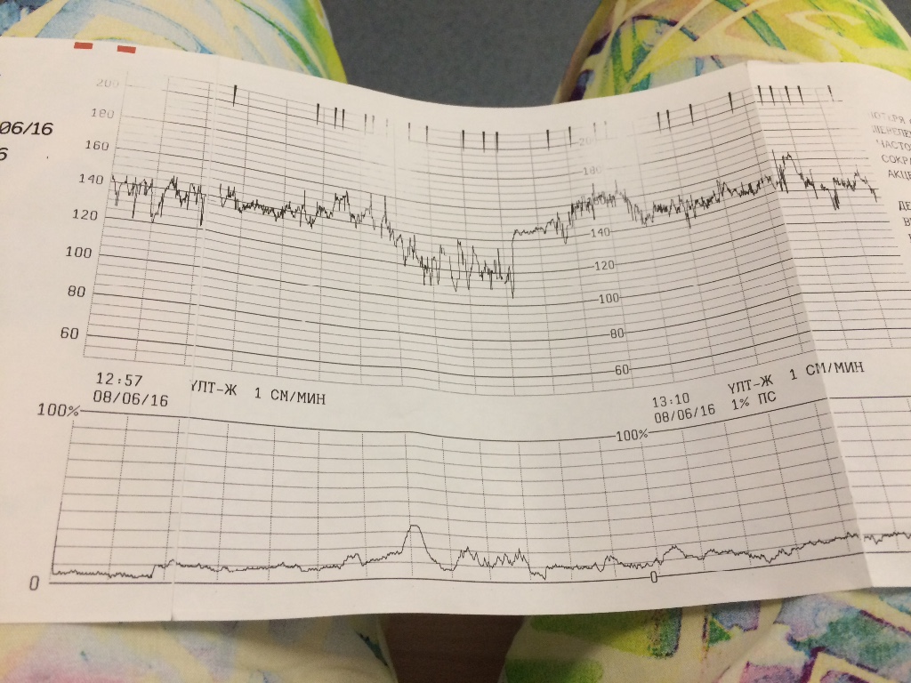 Ктг при беременности что это