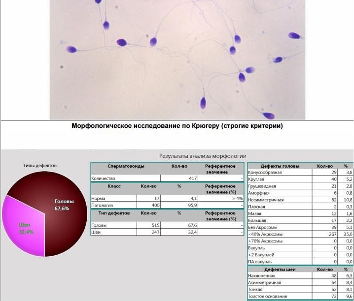 Морфологическое исследование. Нормы анализа спермограммы по Крюгеру. Спермограмма по Крюгеру норма 4. Спермограмма мар тест морфология по Крюгеру. Спермограмма морфология по Крюгеру расшифровка результатов.