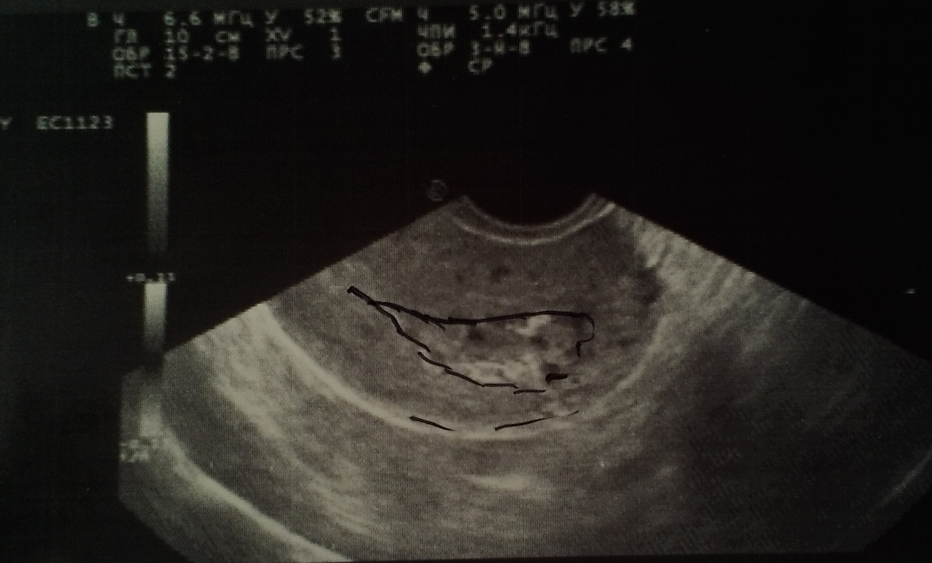 Кровить 6 недель беременности