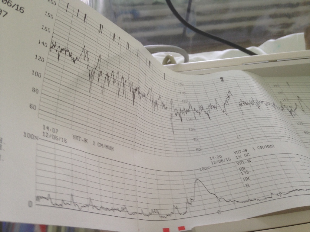 Схватки на ктг. Схватка по КТГ. КТГ на 40 неделе. КТГ на схватках.