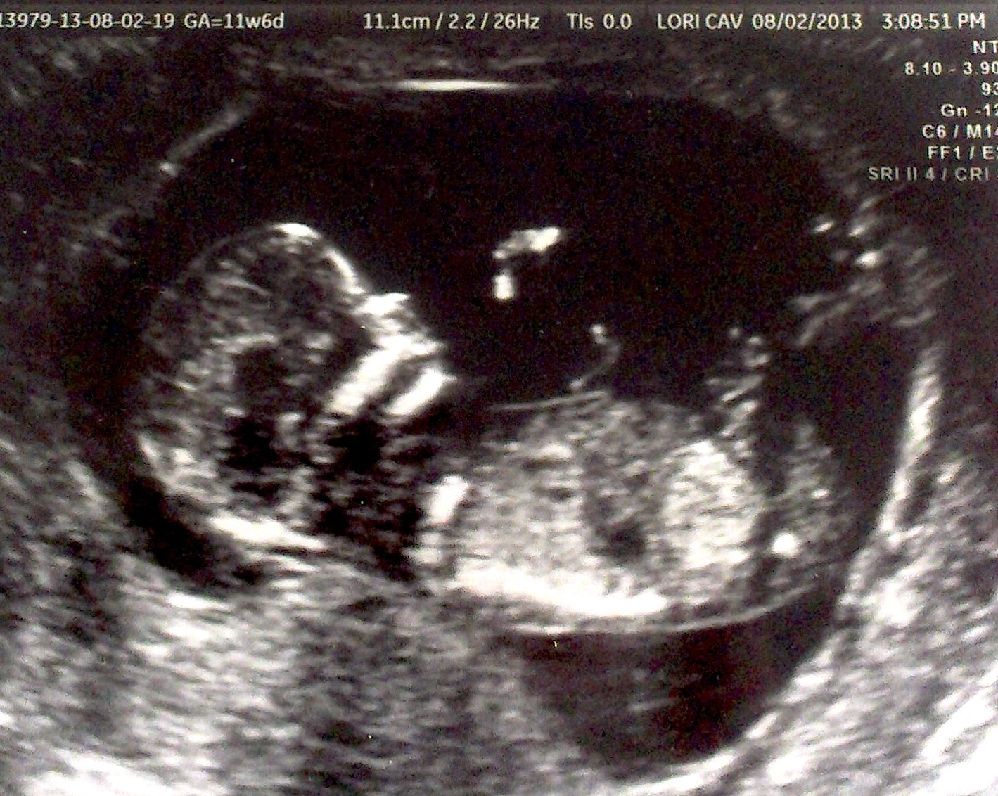 Как выглядит плод 11 12 недель беременности фото
