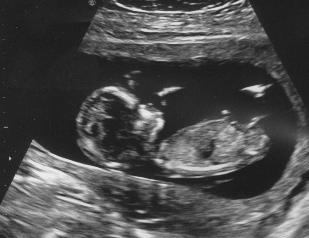 13 неделя коричневые. Ребёнок на 13 неделе беременности. Движение малыша на 13 неделе беременности.