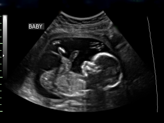 Узи 16 недель беременности пол ребенка фото