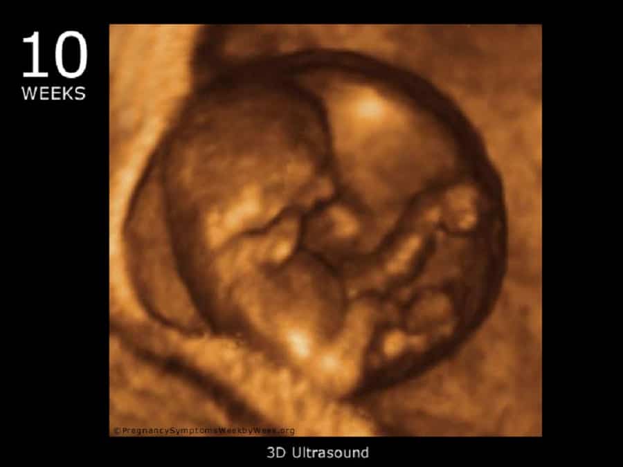 Десятка недели. УЗИ ребенка на 10 неделе беременности. 10 Недель беременности фото плода на УЗИ. УЗИ 10 недель беременности 4д. Как выглядит на УЗИ плод 10 недель.