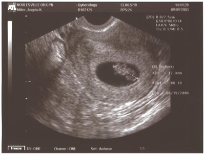 Через 6 8 недель. УЗИ плода 7-8 недель беременности. УЗИ на 8 неделе беременности акушерской. Снимок УЗИ эмбриона на 8 неделе беременности. Снимок УЗИ на 7-8 неделе беременности.