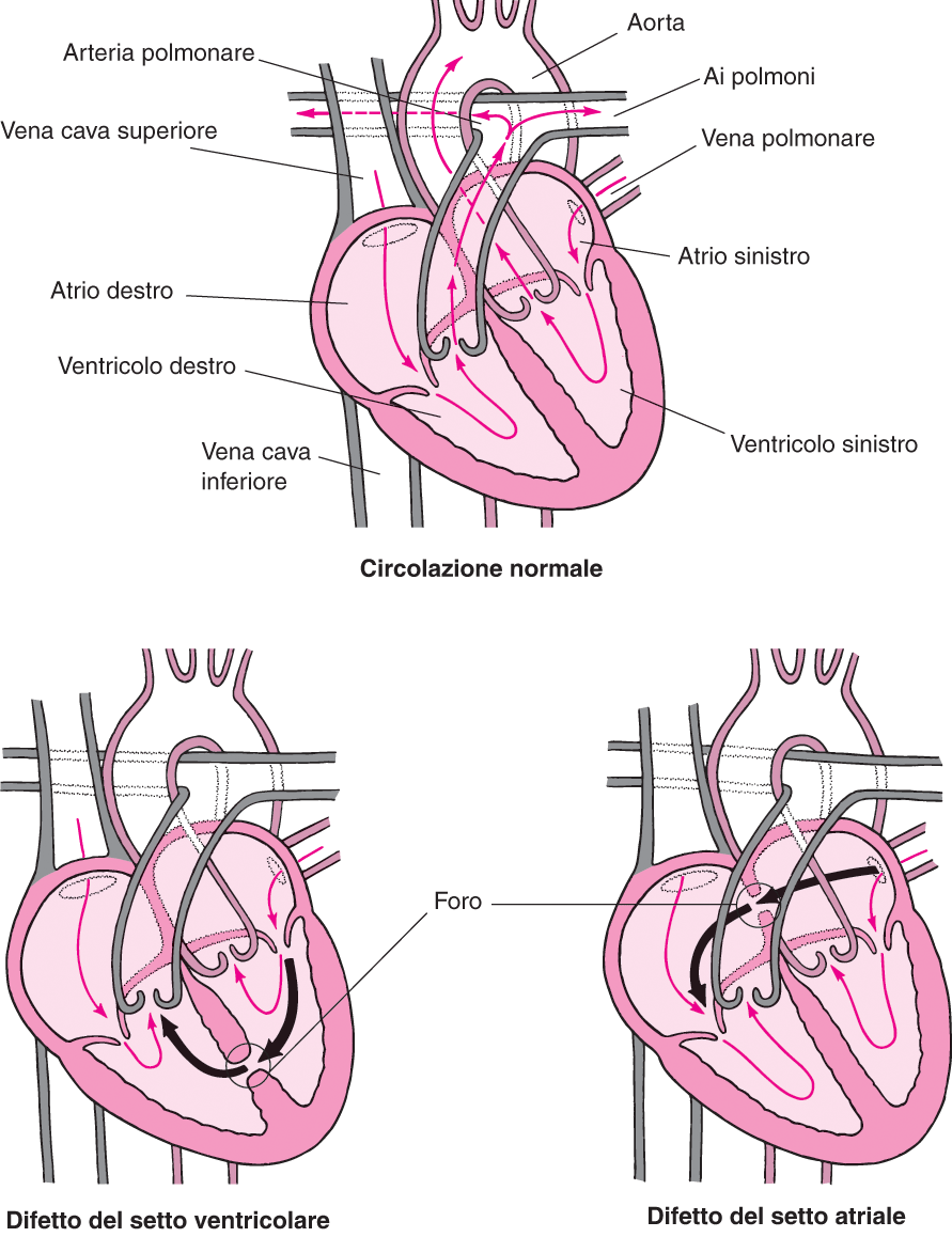 Отверстия в предсердиях. Межпредсердная перегородка сердца. ASD (Atrial Septal defect). Дефект межпредсердной перегородки. Врожденный порок сердца овальное окно.