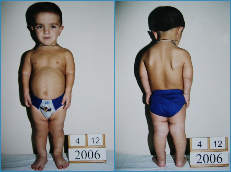 Синдром ларона фото у детей признаки