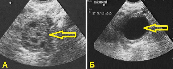 Лютеиновая киста яичника на узи фото