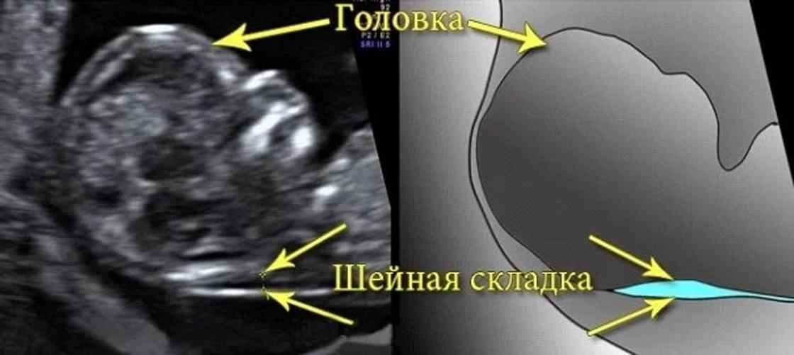 Узи аномалий. УЗИ 1 триместр беременности синдром Дауна. ТВП 12 недель синдром Дауна. Толщина воротникового пространства УЗИ.