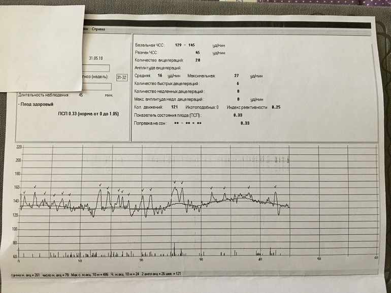 Ктг плода при беременности