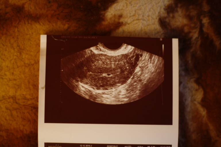 Узи на ранних сроках беременности фото 4 недели беременности