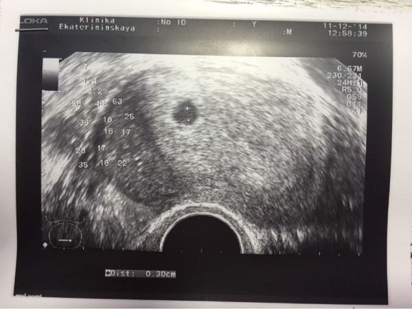 Узи 2 недели беременности от зачатия фото