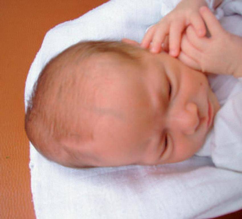 У ребенка пульсирует родничок. Кефалогематома у новорожденного. Теменная кефалогематома. Форма головы у грудничка.