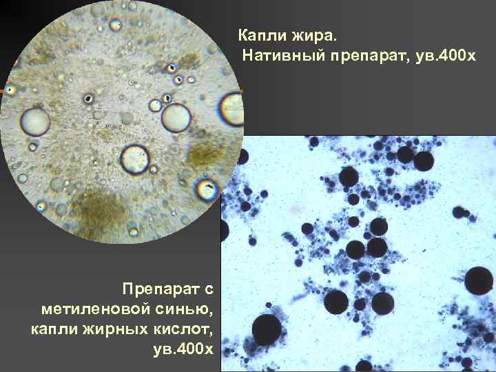 Иглы жирных кислот в кале у ребенка фото