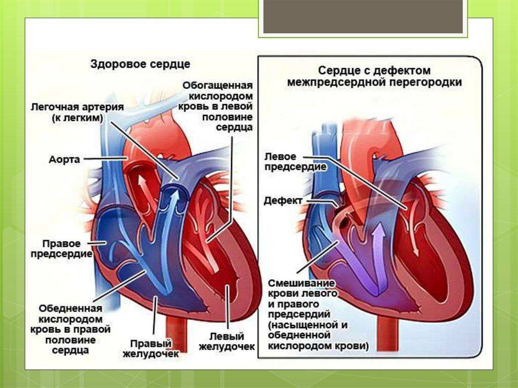Сердце приведет часть 1. Пороки межпредсердной перегородки гемодинамика. Врожденный порок сердца межпредсердной перегородки. Гемодинамика дефекта межпредсердной перегородки сердца. Шунт межпредсердной перегородки.