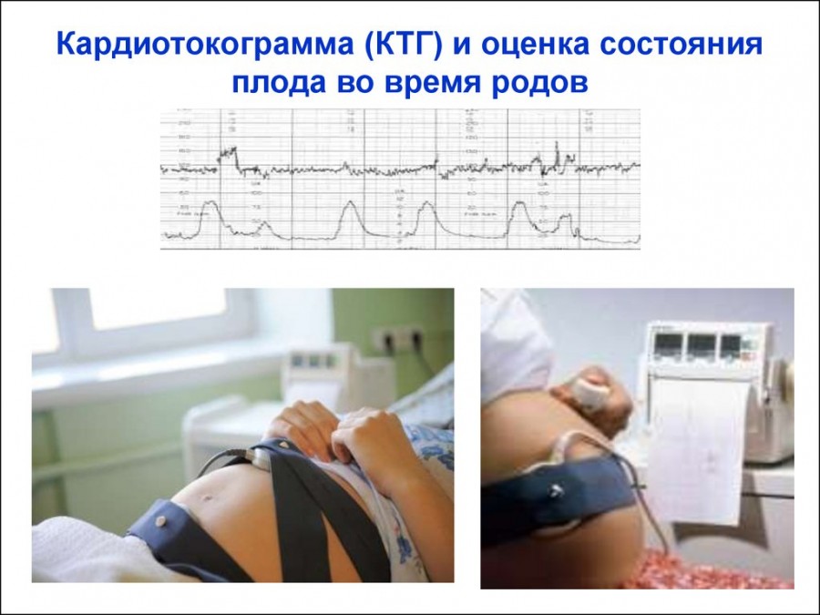 Ктг при беременности что. Алгоритм оценка состояния плода методам КТГ. Кардиотокография плода методика проведения. Кардиотокография плода (КТГ). КТГ при беременности 3 триместр плода.