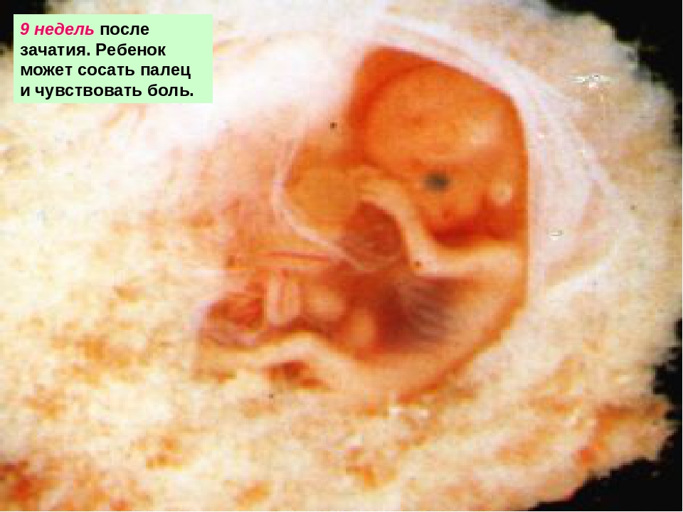 Зародыш 9 недель. Плод на 10 неделе беременности. Плод на 9 неделе беременности. Ребёнок на 10 неделе беременности. Плод на 9-10 неделе беременности.